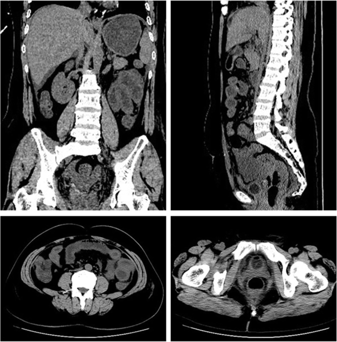 Streptococcal toxic shock syndrome in the setting of recent gynecologic  surgery: A case report - ScienceDirect