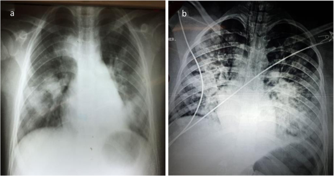 Description of two fatal cases of melioidosis in Mexican children with  acute pneumonia: case report | BMC Infectious Diseases | Full Text