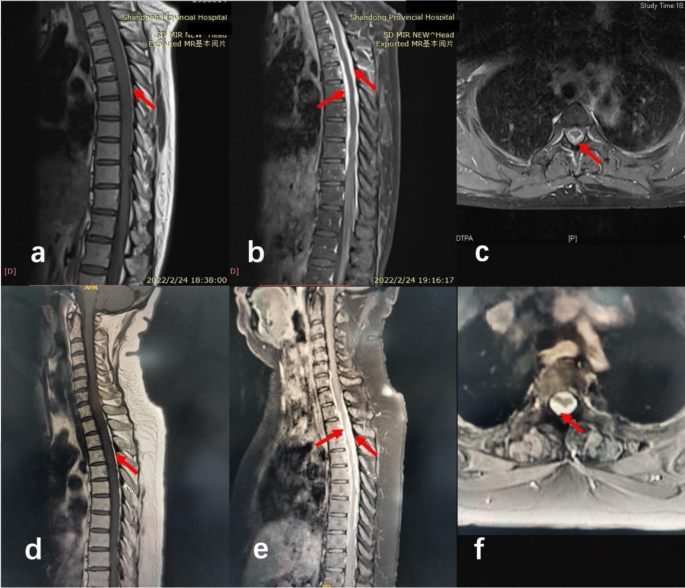 Clinical and pathological features of cerebrospinal meningitis caused