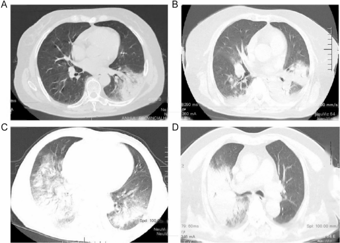 Symptoms of Psittacosis in Humans: Early Signs You Should Know