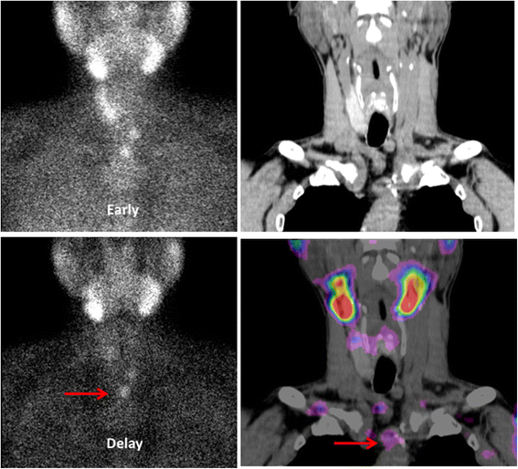 based diagnostic performance of dual phase 99mTc-MIBI SPECT/CT imaging and ultrasonography in patients with secondary hyperparathyroidism | BMC Medical Imaging | Full Text