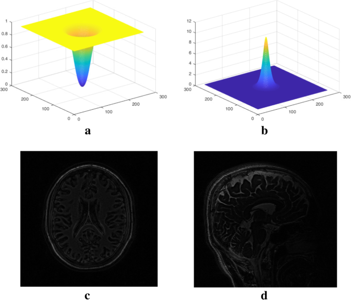 HF-SENSE: an improved partially parallel imaging using a high-pass filter |  SpringerLink