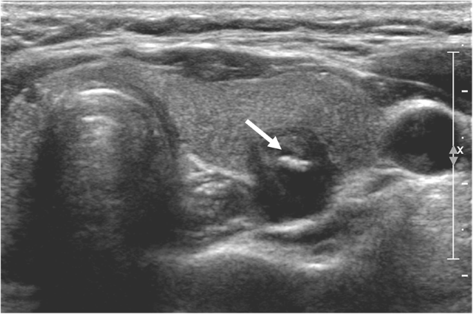 Echogenic foci in thyroid nodules: diagnostic performance with combination  of TIRADS and echogenic foci | BMC Medical Imaging | Full Text