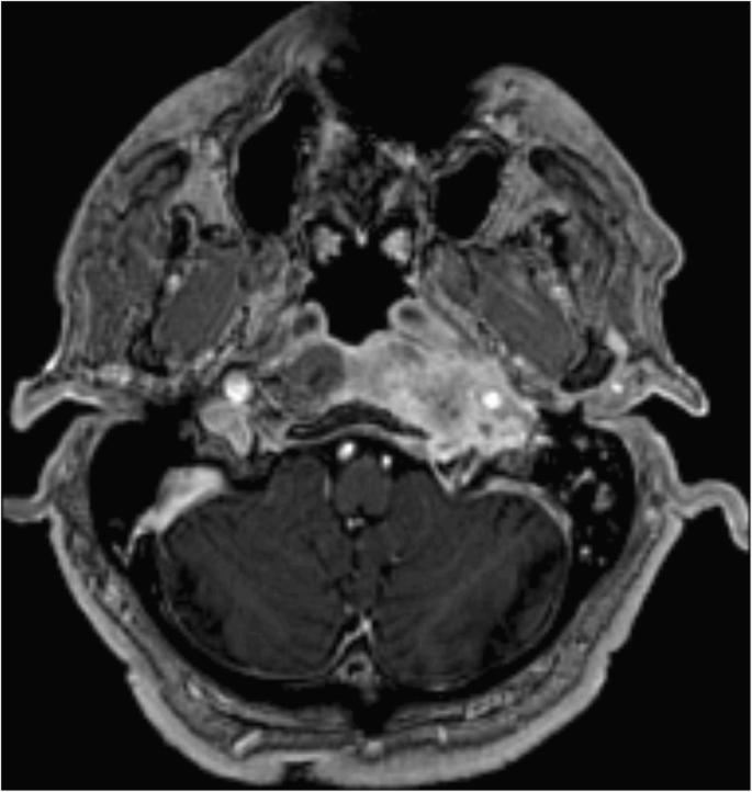The Routes Of Infection Spread In Central Skull Base Osteomyelitis And The Diagnostic Role Of Ct And Mri Scans Bmc Medical Imaging Full Text
