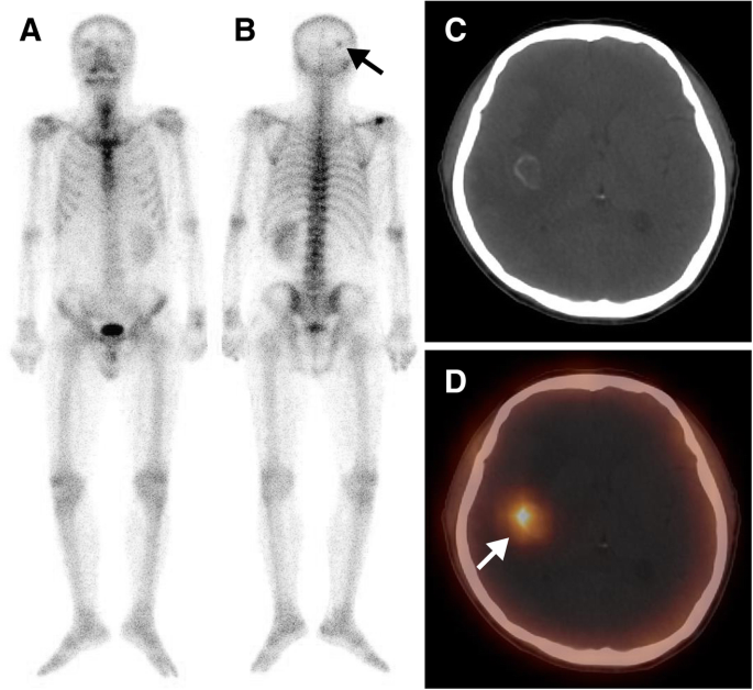 Accurate characterization of 99mTc-MDP uptake in extraosseous neoplasm  mimicking bone metastasis on whole-body bone scan: contribution of SPECT/CT  | BMC Medical Imaging | Full Text