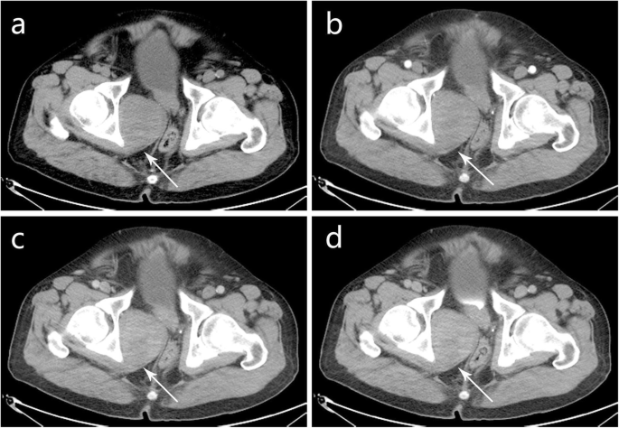 Localized Biphasic Malignant Mesothelioma Presenting As A Giant Pelvic Wall Mass A Rare Case Report And Literature Review Bmc Medical Imaging Full Text