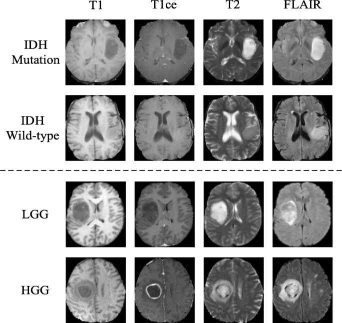 Deep semi-supervised learning for brain tumor ...