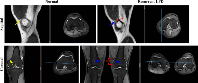 Morphological study of the vastus medialis oblique in recurrent patellar  dislocation based on magnetic resonance images | BMC Medical Imaging | Full  Text