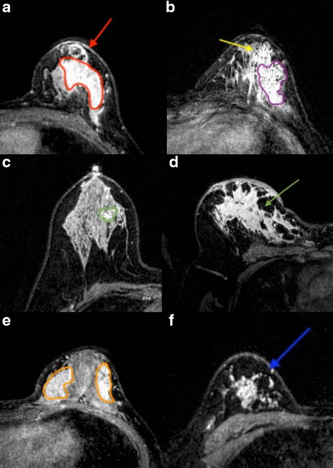 Additive value of texture analysis based on breast MRI for 