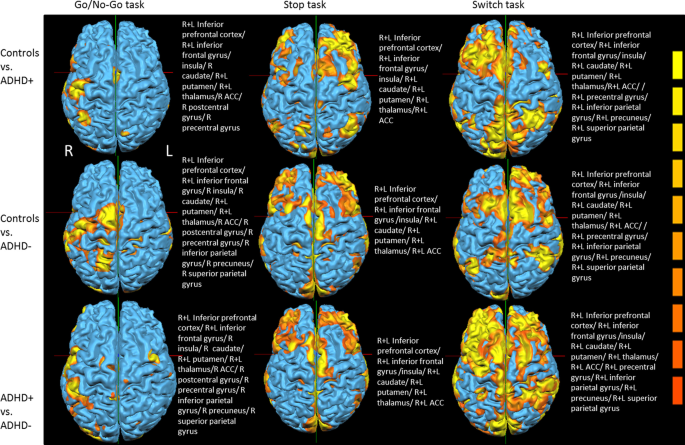 Brain activation patterns in medicated versus medication-naïve adults with  attention-deficit hyperactivity disorder during fMRI tasks of motor  inhibition and cognitive switching | BMC Medical Imaging | Full Text