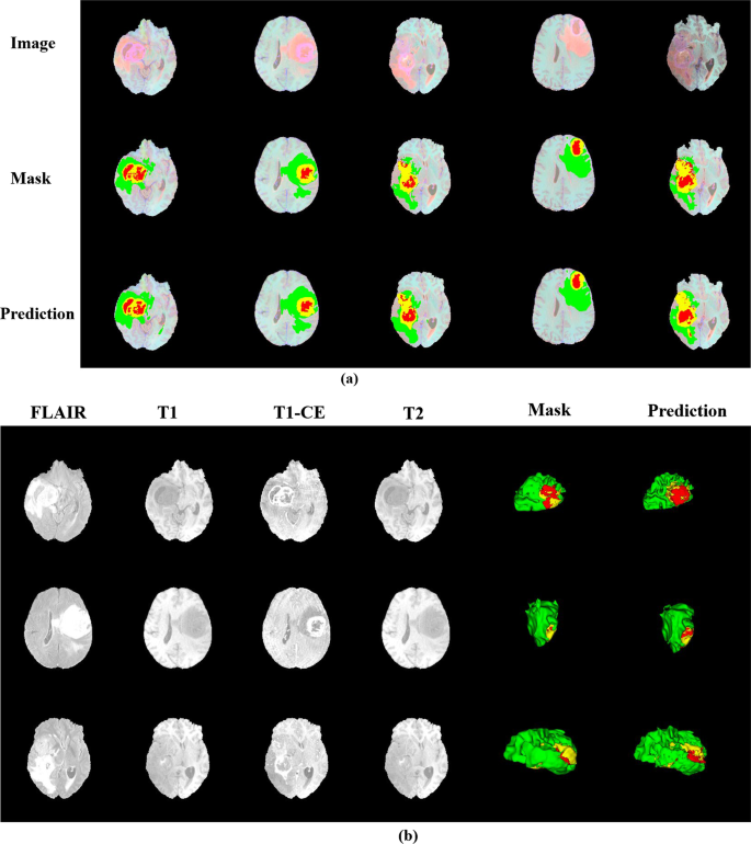 Brain tumor segmentation based on deep learning and an attention mechanism  using MRI multi-modalities brain images