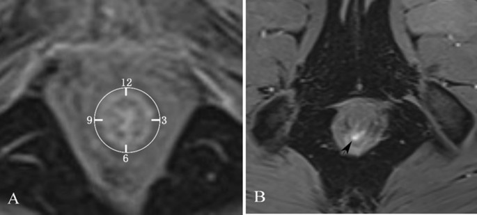 Accuracy of magnetic resonance imaging in defining dentate line in anal fistula BMC Medical Imaging Full Text