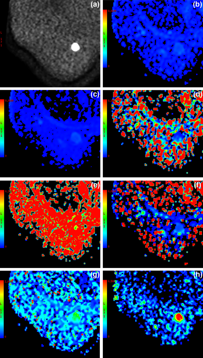 ADC values (mm2/s) of tumor and liver at different time points.