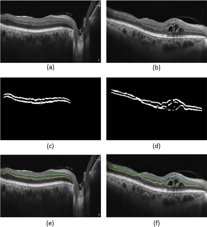 retinal layers oct