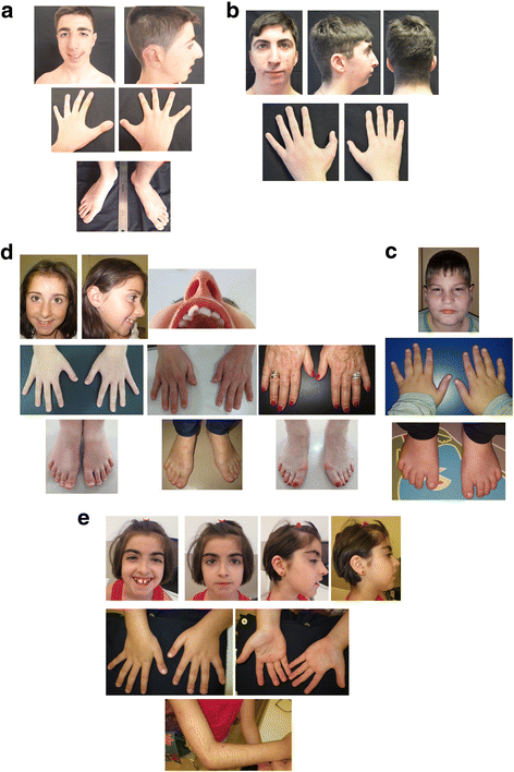 A case with Rubinstein-Taybi syndrome: A novel frameshift mutation