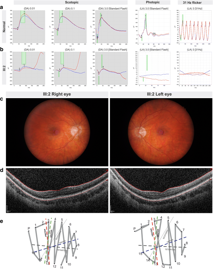 A 73,128 bp de novo deletion encompassing the OPN1LW/OPN1MW gene cluster in  sporadic Blue Cone Monochromacy: a case report | BMC Medical Genetics |  Full Text