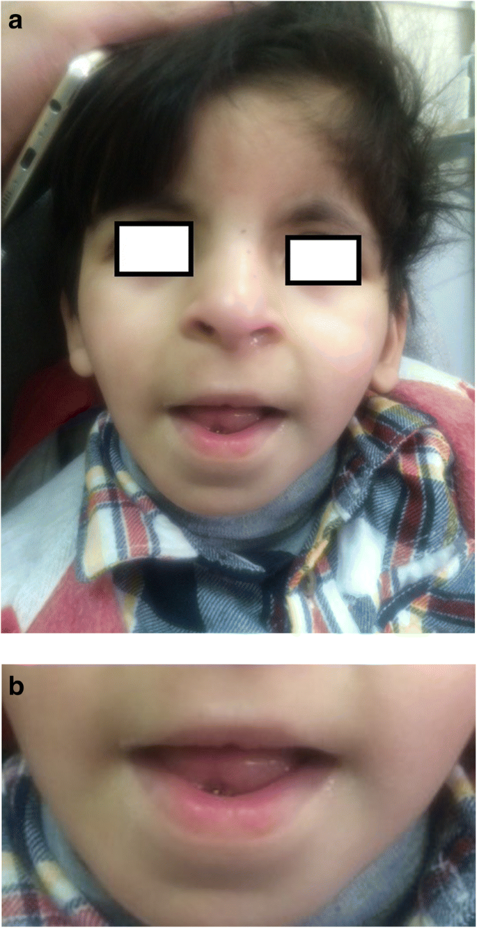 Ultra-Rare Syndromes: The Example of Rubinstein-Taybi Syndrome. - Abstract  - Europe PMC