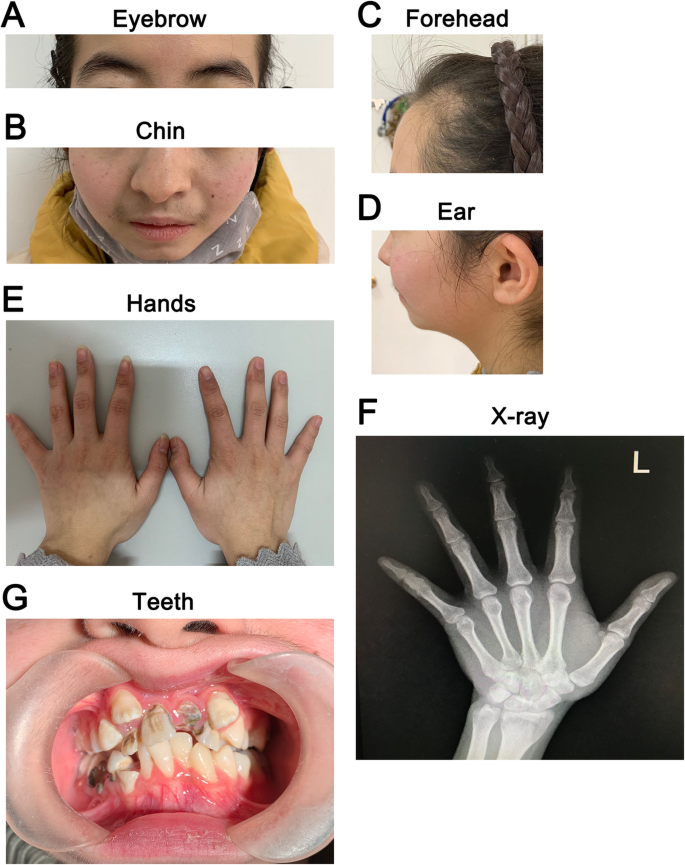 A novel PIK3R1 mutation of SHORT syndrome in a Chinese female with diffuse  thyroid disease: a case report and review of literature | BMC Medical  Genetics | Full Text