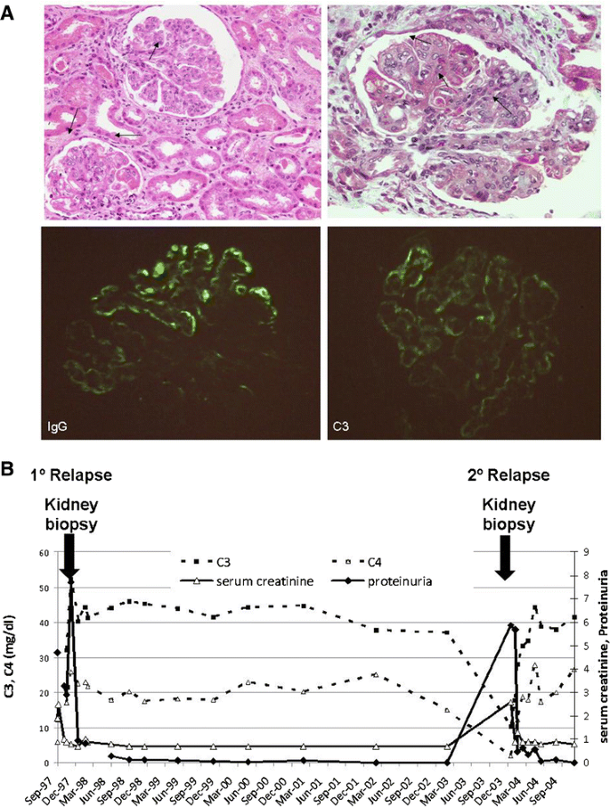 Case report: lupus nephritis with autoantibodies to complement alternative  pathway proteins and C3 gene mutation | BMC Nephrology | Full Text