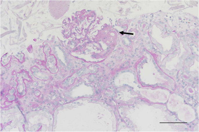 Sunitinib-related high-grade proteinuria and allograft dysfunction in a  kidney recipient: a rare case report | BMC Nephrology | Full Text