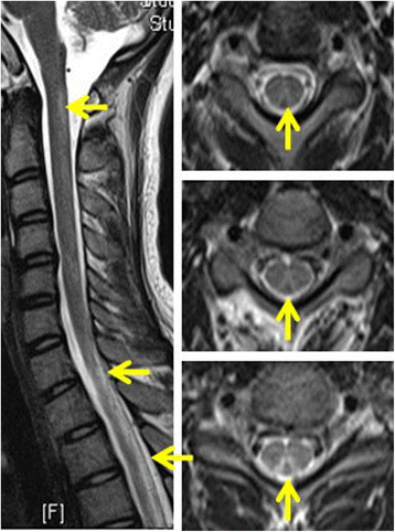 Nitrous oxide induced subacute combined degeneration with longitudinally  extensive myelopathy with inverted V-sign on spinal MRI: a case report and  literature review | BMC Neurology | Full Text