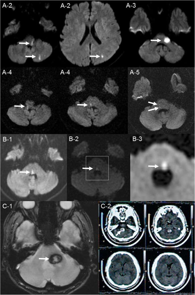 Patterns Of Pontine Strokes Mimicking Bell S Palsy Bmc Neurology Full Text