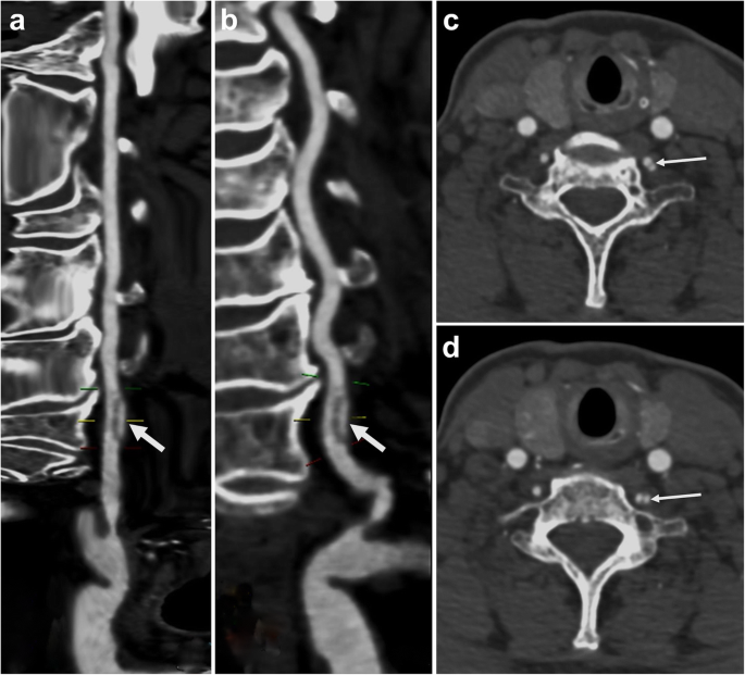 vertebral artery