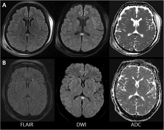 Lithium Induced Reversible Splenial Lesion In Neuroleptic Malignant Syndrome Like Symptoms Two Case Reports Bmc Neurology Full Text