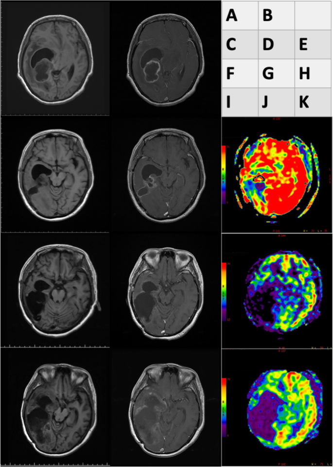 Spinal metastasis of glioblastoma multiforme before gliosarcomatous  transformation: a case report | BMC Neurology | Full Text