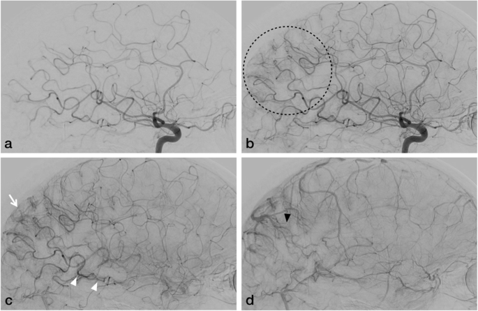 leptomeningeal angiomas