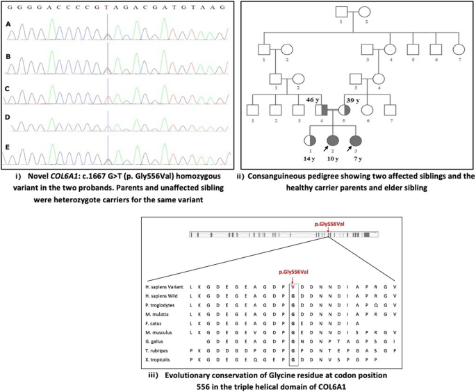 A Novel Variant In The Col6a1 Gene Causing Ullrich Congenital Muscular Dystrophy In A Consanguineous Family A Case Report Bmc Neurology Full Text