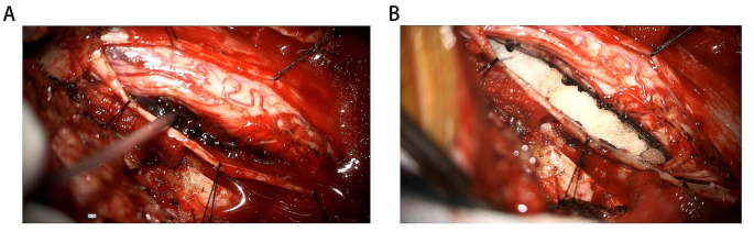 Malignant melanotic schwannoma of the cervical spinal cord: a case report |  BMC Neurology | Springer Nature Link