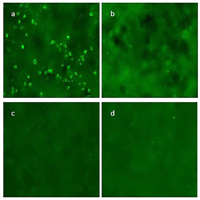 Antidopamine receptor 2 antibody encephalitis in adults a case report