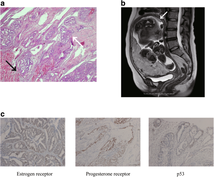 endometrial cancer on pregnancy)