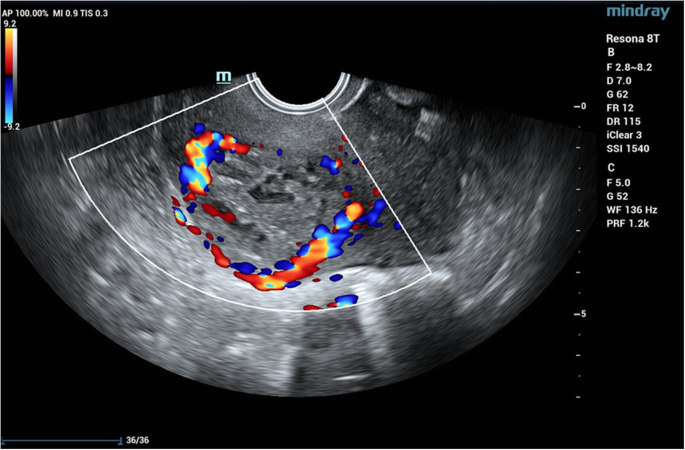 Uterine Mass After Caesarean Section A Report Of Two Cases Bmc Pregnancy And Childbirth Full Text
