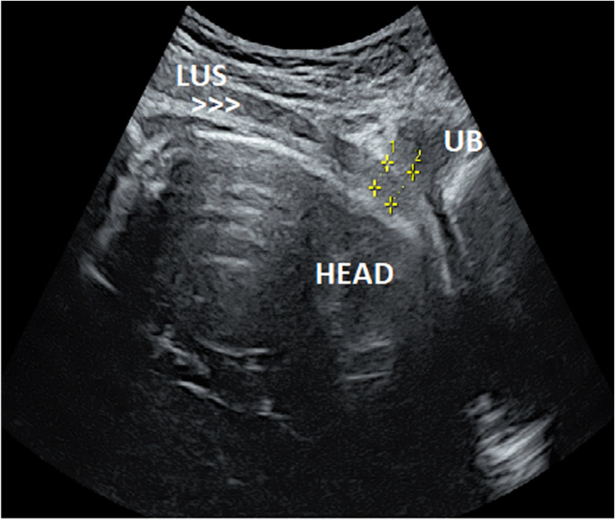 Intrapartum ultrasound measurement of the lower uterine segment thickness in  parturients with previous scar in labor: a cross-sectional study | BMC Pregnancy  and Childbirth | Full Text