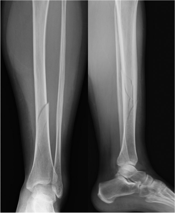 Suprapatellar intramedullary nailing of tibial shaft fractures in  pregnancy. A report of two cases | BMC Pregnancy and Childbirth | Full Text
