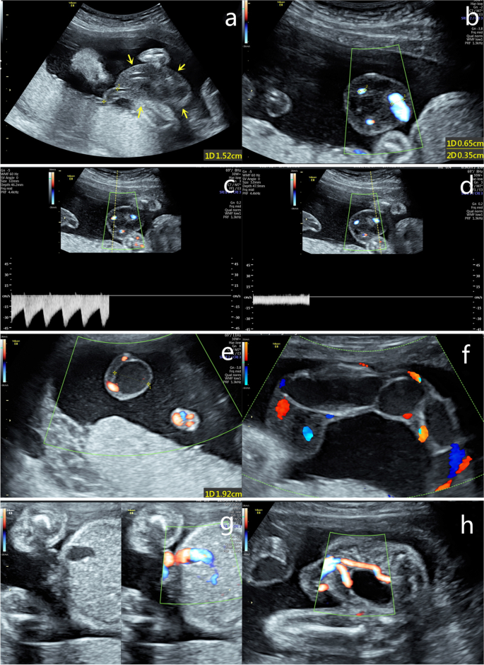 Cross compression view of the ACOM, Radiology Case