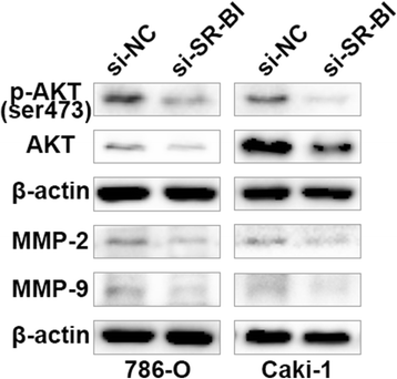 Up Regulation Of Sr Bi Promotes Progression And Serves As A Prognostic Biomarker In Clear Cell Renal Cell Carcinoma Bmc Cancer Full Text