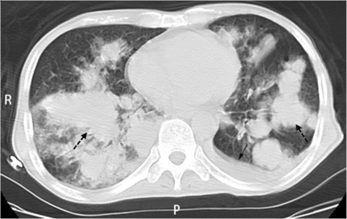 A Lung Cancer Patient With Deep Vein Thrombosis:a Case Report And  Literature Review | Bmc Cancer | Full Text