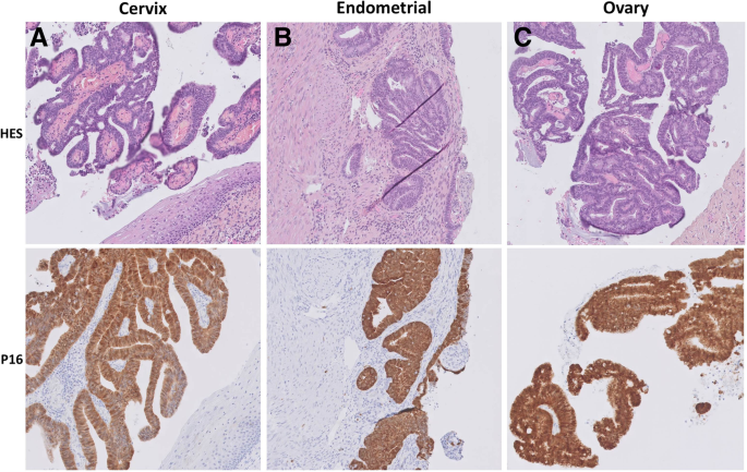 high risk hpv and ovarian cancer ce pastile de vierme beau