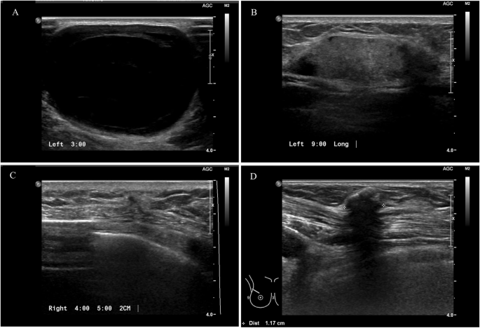 Natural course of fat necrosis after breast reconstruction: a 10-year  follow-up study, BMC Cancer