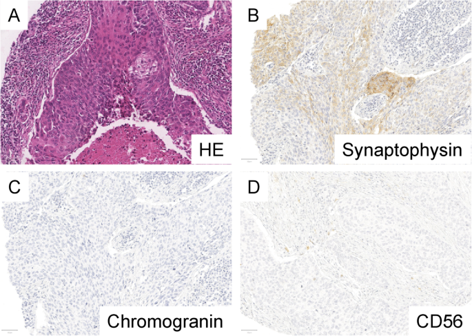 Odds dog agency Role of Synaptophysin, Chromogranin and CD56 in adenocarcinoma and squamous  cell carcinoma of the lung lacking morphological features of neuroendocrine  differentiation: a retrospective large-scale study on 1170 tissue samples |  BMC Cancer 