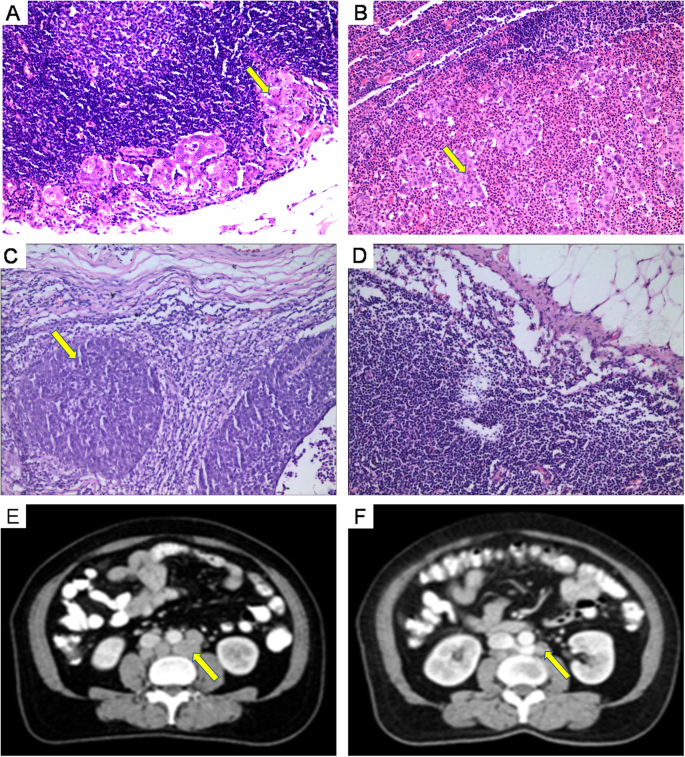 retroperitoneal lymph nodes