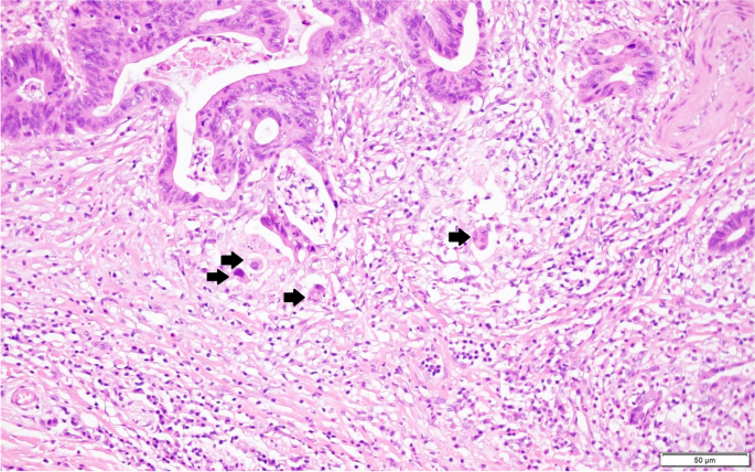 Composite scoring system and optimal tumor budding cut-off number for  estimating lymph node metastasis in submucosal colorectal cancer | BMC  Cancer | Full Text