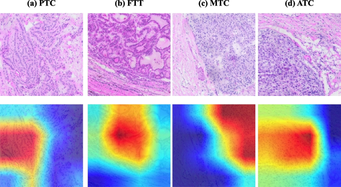 current research on thyroid cancer figure 11