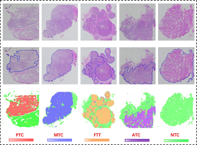 current research on thyroid cancer figure 12