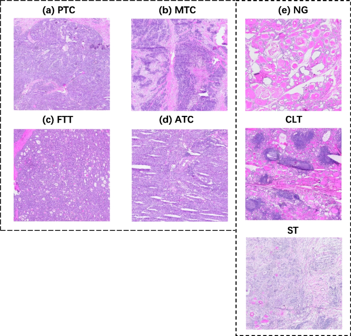 current research on thyroid cancer figure 1