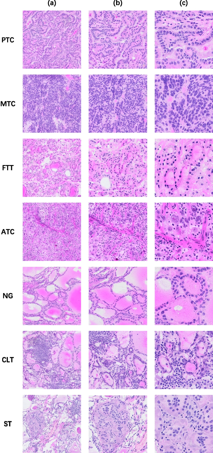 current research on thyroid cancer figure 2