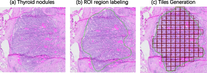 current research on thyroid cancer figure 3